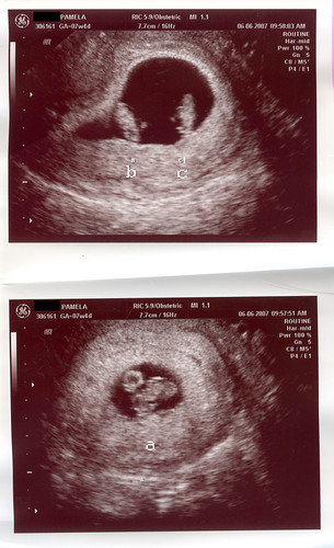 7w 3d ultrasound of triplets